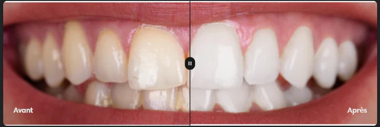 GlorySmile® - Sérum de blanchiment dentaire